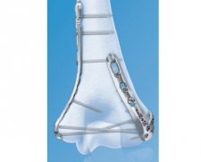 Depuy Synthes VA-LCP Distal Humerus Plates 2.7/3.5 | Used in Fracture fixation  | Which Medical Device